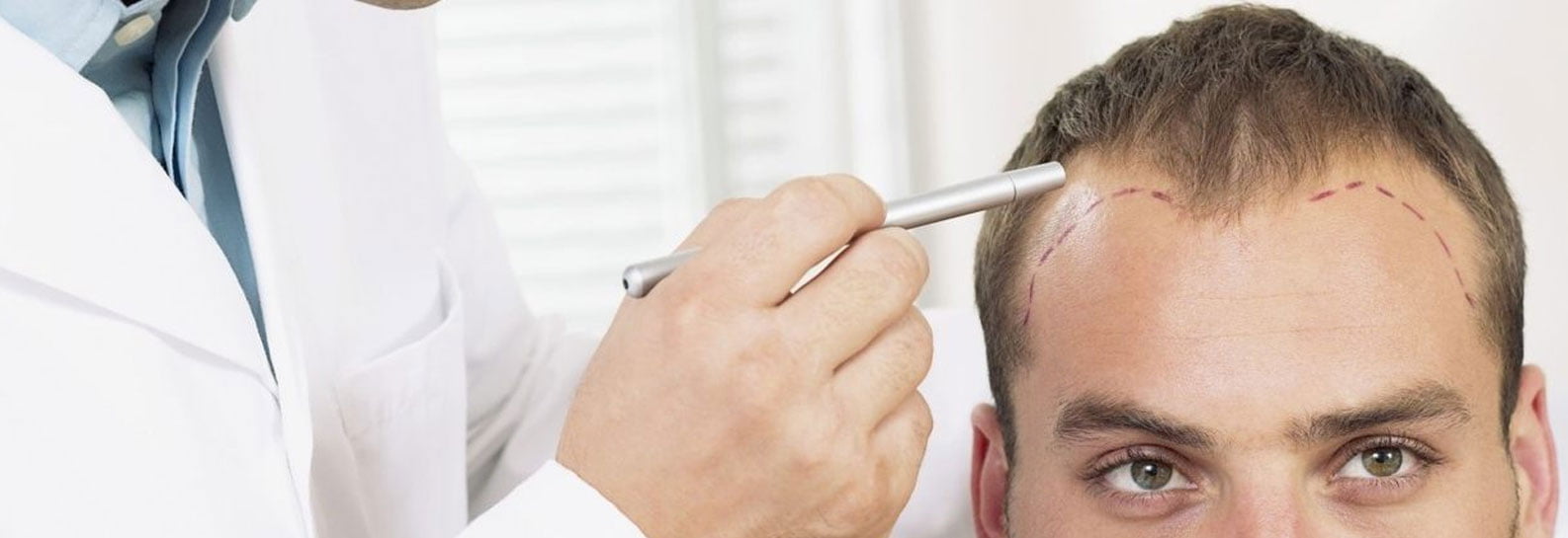 FUT-hair-transplant