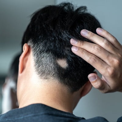 Alopecia Areata Treatment in Islamabad.