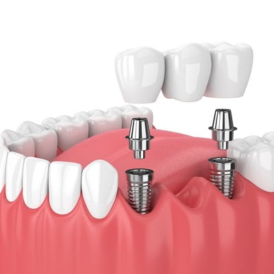 Cost of Dental Implant in Islamabad Pakistan