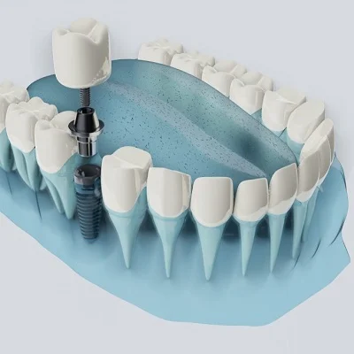 Dental Implant in Islamabad Pakistan - Best Dentist For Dental Implants