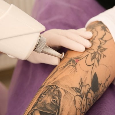 Laser Tattoo Removal in Islamabad