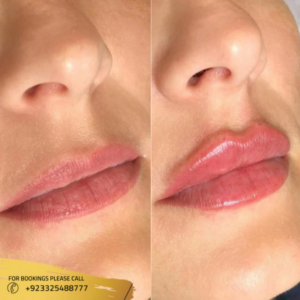 lip fillers before and after