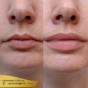 lip fillers cost in islamabad pakistan