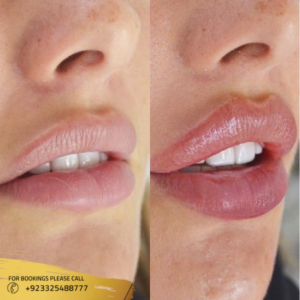 results of lip fillers in islamabad pakistan