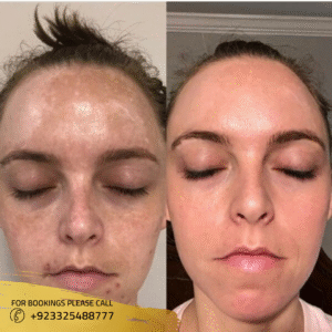 Skin Pigmentation Treatment price in Islamabad