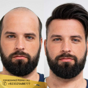 Hair Wigs in Islamabad, Rawalpindi, and Pakistan Hair Wigs in Islamabad, Rawalpindi, and Pakistan
