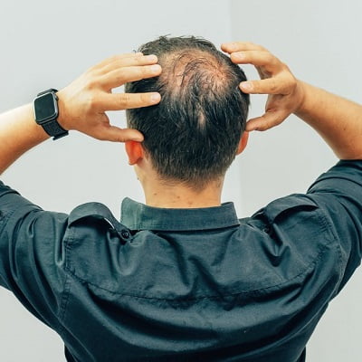 What Is The Best Treatment For Baldness In Men In Islamabad Pakistan?
