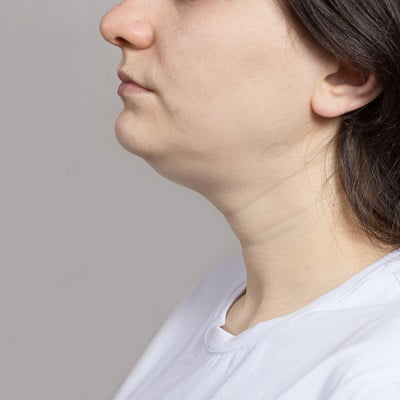 Is There A Procedure To Remove Fat From Face In Islamabad