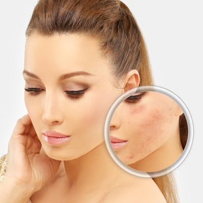 Laser Treatment for acne scars cost in Islamabad.