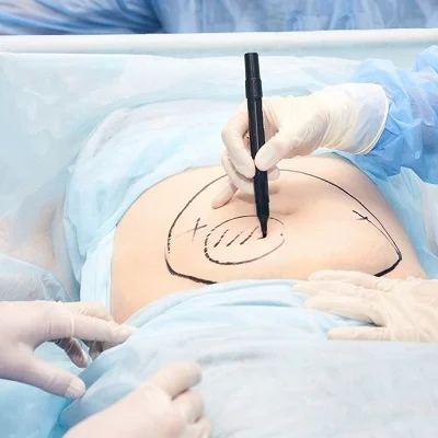 Tummy Tuck in Islamabad