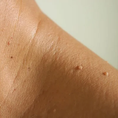 Skin Tag Removal in islamabad