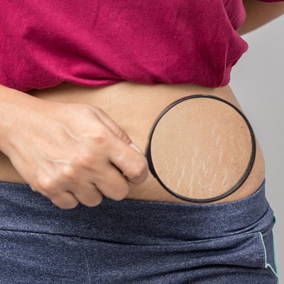 stretch marks removal in Islamabad-Pakistan