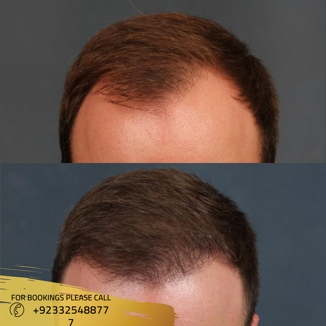hair transplant Cost Islamabad