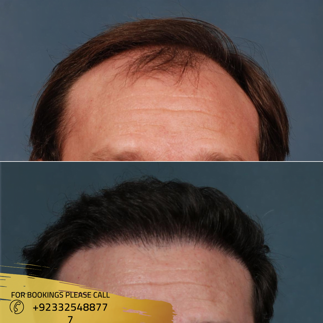 Best Hair Transplant in Islamabad