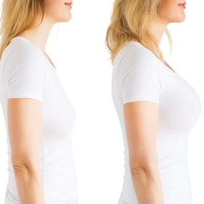 Breast Surgery for Bigger Breast in Islamabad.
