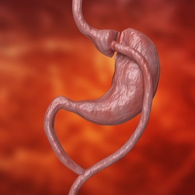 Cost of Bariatric Surgery in Islamabad