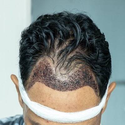 Front Line Hair Fixing in Islamabad - RCS