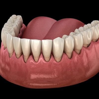 Gum Recession Treatment in Islamabad