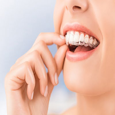 Invisible Braces cost in Islamabad