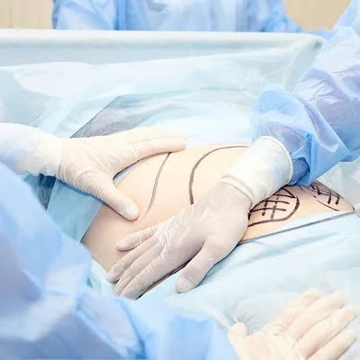 Liposuction in Islamabad, Pakistan