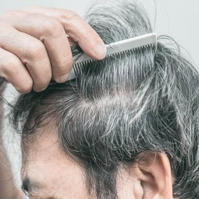 Natural Hairline Treatment in Islamabad