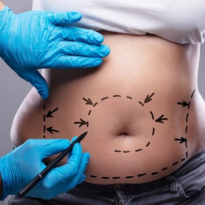 best liposuction surgery in royal cosmetic clinic.