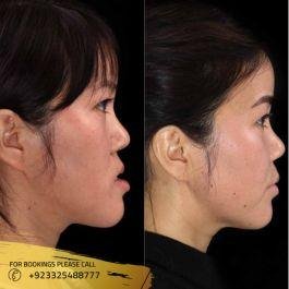 jaw surgery before and after cost
