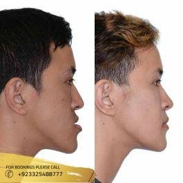 jaw surgery before and after male