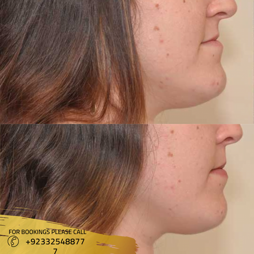 Bite Correction surgery in Islamabad
