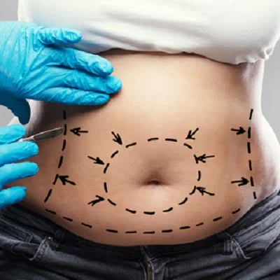 Best Abdominoplasty Cost in Islamabad