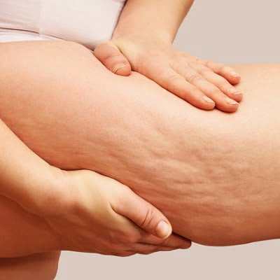 Cellulite removal treatment cost in Islamabad