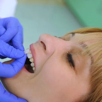 Dental veneers cost in islamabad