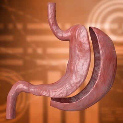 How much does gastric sleeve cost in Pakistan?