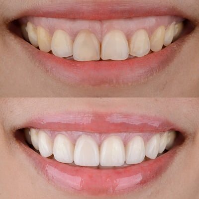 Gummy Smile Treatment