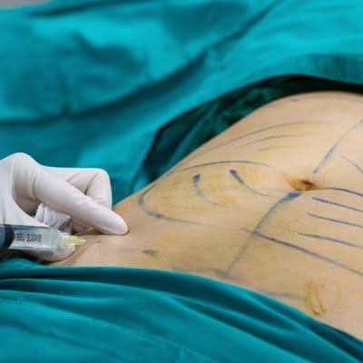 High-definition liposculpture in Islamabad