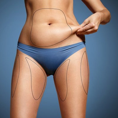 Price for liposuction 2022 in Islamabad