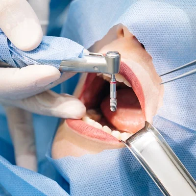 Dental Implants