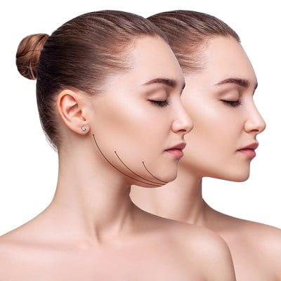 Neck Liposuction Cost in Islamabad