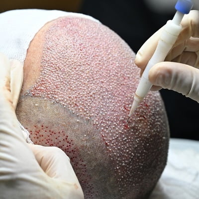 2 Best Hair Transplant Methods in Islamabad 2 Best Hair Transplant Methods in Islamabad