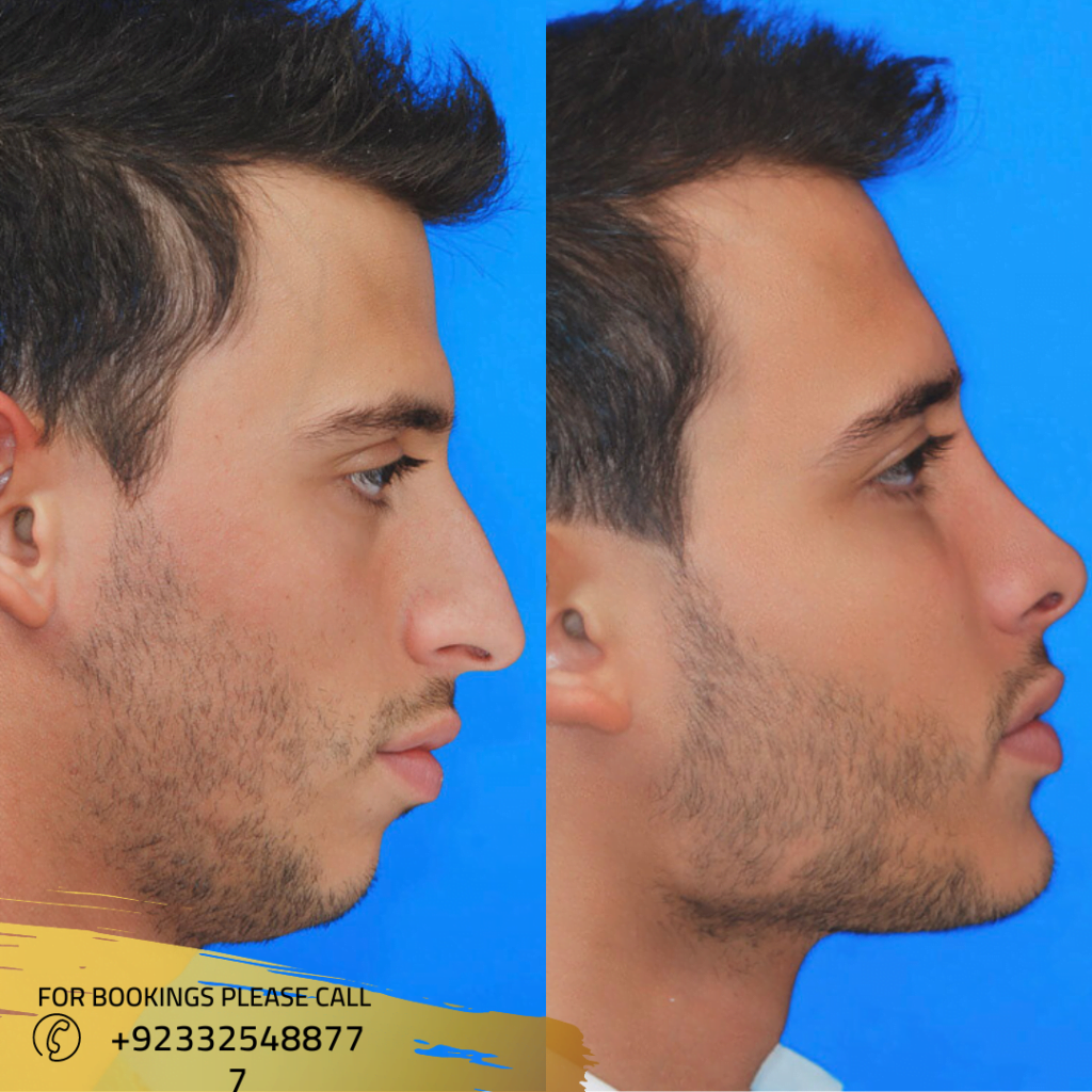 Jaw Surgery in Islamabad, Rawalpindi & Pakistan Maxillofacial Surgeon
