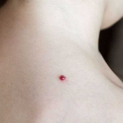 Hemangiomas Treatment In Islamabad