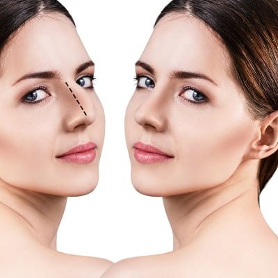 Scarless rhinoplasty (closed rhinoplasty)