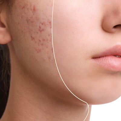 Treat Your Acne Scars With PRP Microneedling in Islamabad