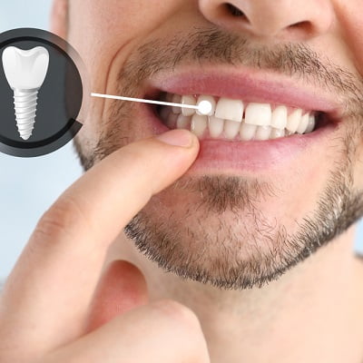 5 Myths About Dental Implant, Busted!