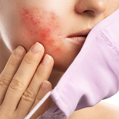 What’s Causing the New Acne,Maskne in Islamabad and How to Treat It