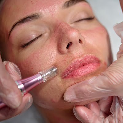 Is microneedling a waste of money?