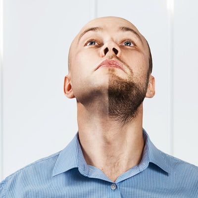 beard transplant