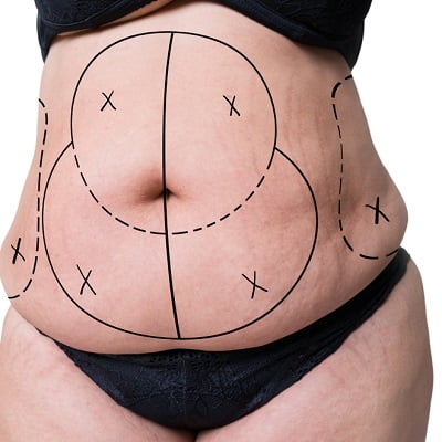 Liposuction and cellulite