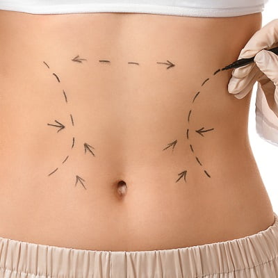 Which five questions concerning liposuction should I ask my doctor?