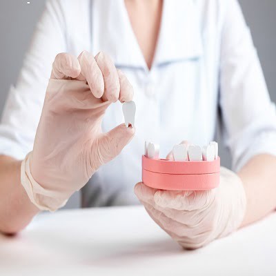 Dental Implants: A Long-Term Replacement for Missing Teeth